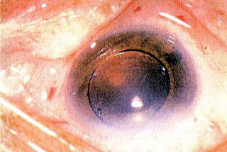 結膜手術 福岡市の眼科 白内障 網膜硝子体手術 緑内障手術 望月眼科